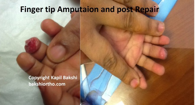 Finger Tip Amputation with exposed bone