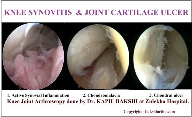 Knee Synovitis &amp; Chondral Ulcers