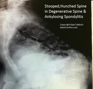 Ankylosing &amp; Degenerative Arthritis