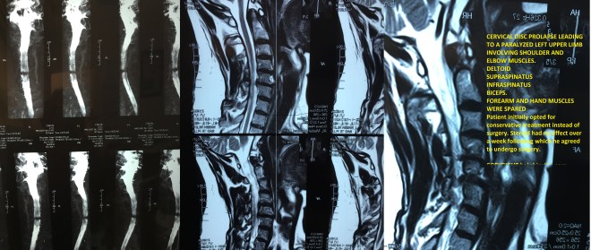 Cervical Disc prolapse with paralysis of Lt Upper Limb