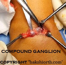 Ganglion Dorsum of Wrist