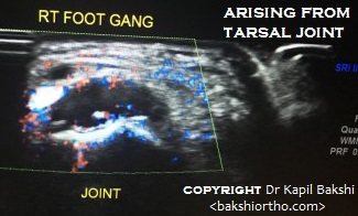 Ganglion with Intrarticular Extension
