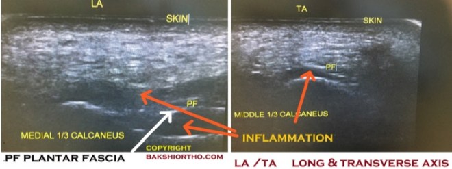 Plantar Fascia Ultrasound showing Inflammation