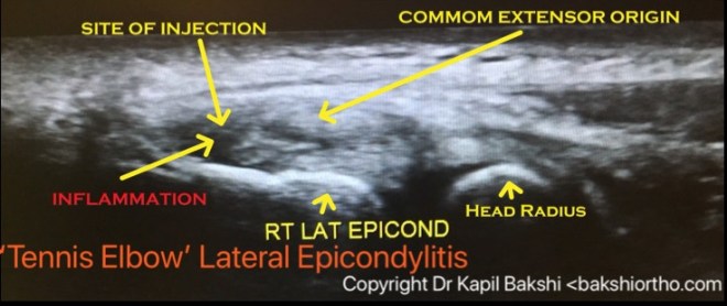 tennis_elbow_ultrasound