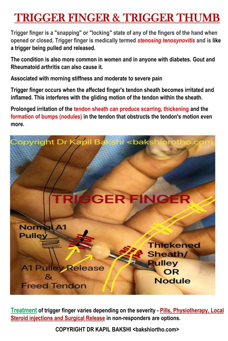 Rt Trigger Finger Modifier TRIGGER FINGER-1 (1) – Dr. Kapil Bakshi (Bakshi Orthopaedics – A ...
