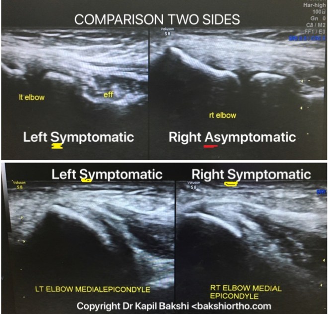 Comparison two sides ultrasound pathology