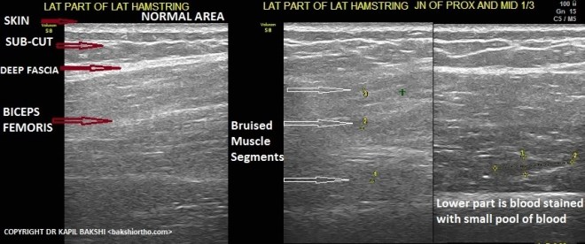 Normal &amp; Bruised Hamstring