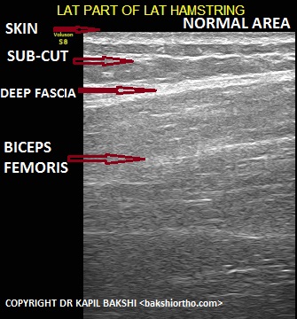 Normal Muscle Area Biceps Femoris