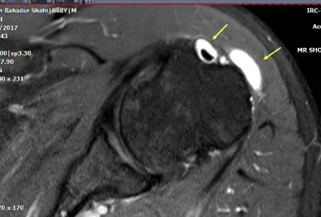 Sub Acromial Bursitis MRI. gan