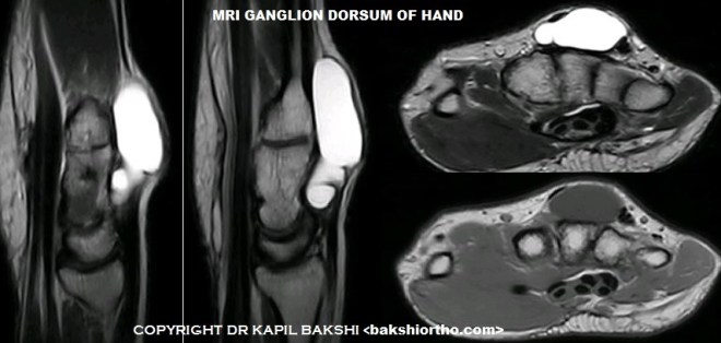 Ganglion MRI sr