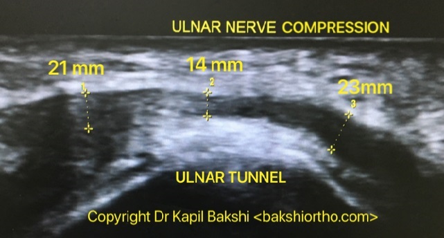 Ulnar Nerve compression at Tunnel