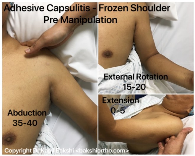 Frozen shoulder Pre Manipulation