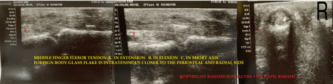 Intratendinous FB middle flexor hand